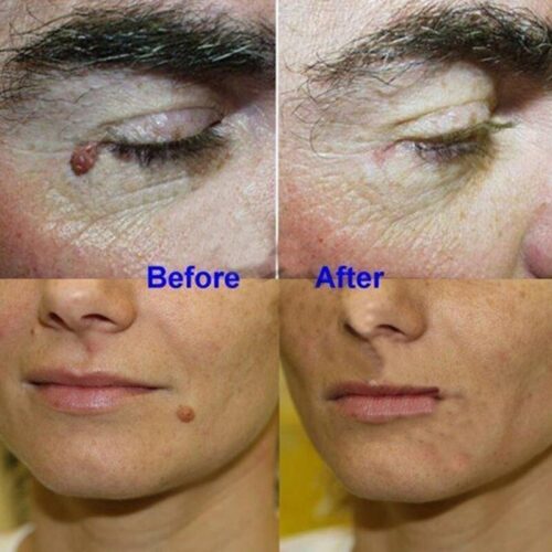 Instant Mole Remover Lotion