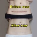 Scar Recovery Cream Fast Removal Skin Scars Treat of Surgery Scars Stretch Marks Acne Pox Prints Burn Repair Facial Care Gel
