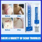 Scar Recovery Cream Fast Removal Skin Scars Treat of Surgery Scars Stretch Marks Acne Pox Prints Burn Repair Facial Care Gel