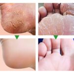 Foot Fungus Removal Cream Relieve Foot Itching Remove Beriberi Dead Skin Foot Sweat Moisturize Repair Foot Cracked Ointment