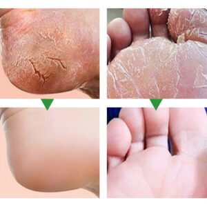 Foot Dead skin and Fungus Remover Moisturizer