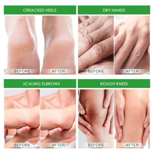 Foot Dead skin and Fungus Remover Moisturizer
