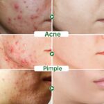 Acne Face Cream Herbal Pimple Scar Removal Shrink Pore Oil Control Moisturizing Facial Cream Acne Treatment Skin Care