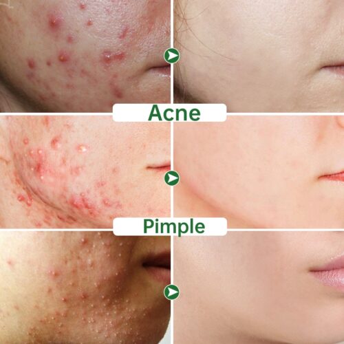 Herbal Acne Removal Cream