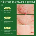 Acne Face Cream Herbal Pimple Scar Removal Shrink Pore Oil Control Moisturizing Facial Cream Acne Treatment Skin Care