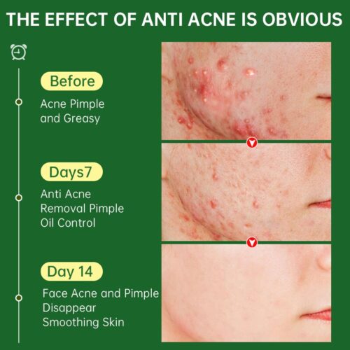 Herbal Acne Removal Cream