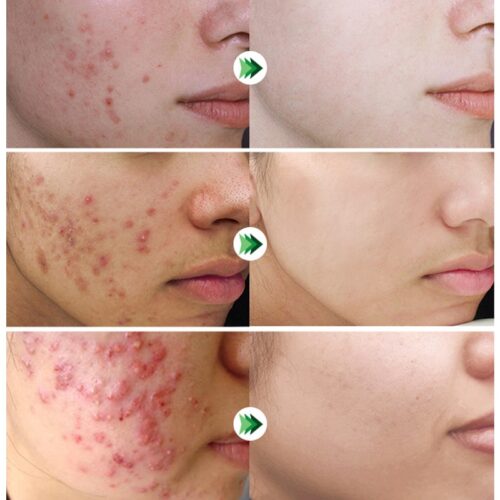 Acne Removal Serum - Unveil clear, blemish-free skin.