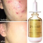 Acne Removal Serum Effective Acne Treatment Repair Scar Spots and Skin Pores Moisturizing Oil Control Skin Care