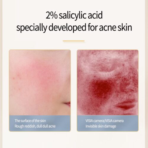 Acne Removal Serum - Unveil clear, blemish-free skin.